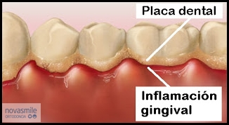 eliminar-placa-dental Eliminar la placa dental